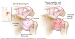 Frozen shoulder and rotator cuff tendonitis