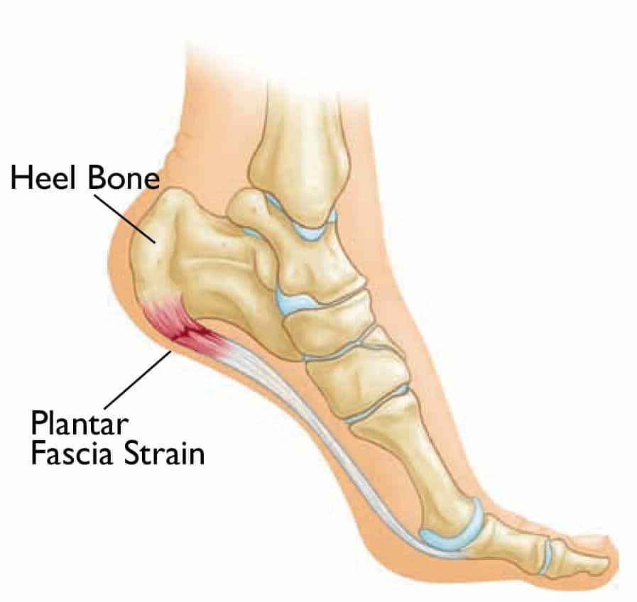 What is Plantar Fasciitis? - Pivotal Physio